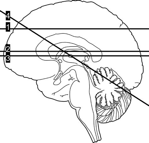 Abnormalities of the Fetal Central Nervous System: .